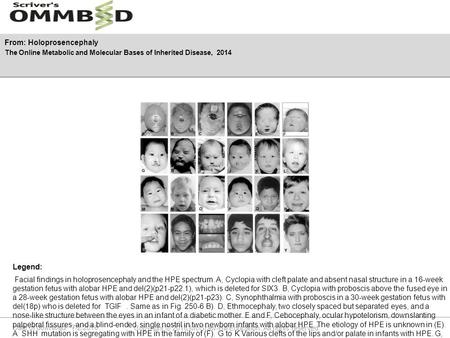 Date of download: 7/2/2016 Copyright © 2016 McGraw-Hill Education. All rights reserved. Facial findings in holoprosencephaly and the HPE spectrum. A, Cyclopia.