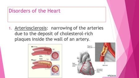 Disorders of the Heart 1. Arteriosclerosis: narrowing of the arteries due to the deposit of cholesterol-rich plaques inside the wall of an artery.