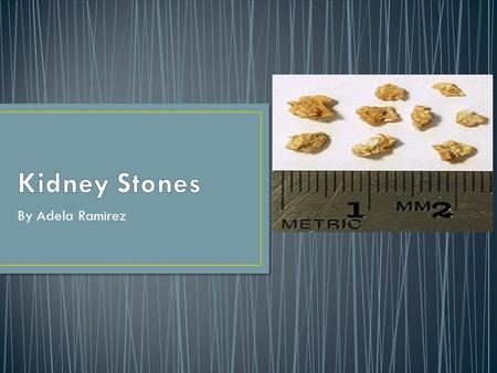 By Adela Ramirez. Kidney stones are small, hard deposits that form inside your kidney. They are made of minerals and acid salts. Kidney stones form when.