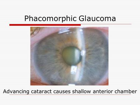 Phacomorphic Glaucoma