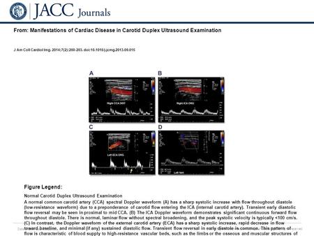 Date of download: 7/6/2016 Copyright © The American College of Cardiology. All rights reserved. From: Manifestations of Cardiac Disease in Carotid Duplex.