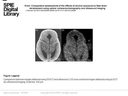 Date of download: 7/6/2016 Copyright © 2016 SPIE. All rights reserved. Comparison between images obtained using SSOCT and ultrasound. 2-D cross-sectional.