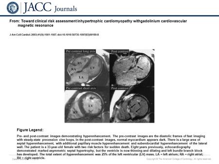 Date of download: 7/7/2016 Copyright © The American College of Cardiology. All rights reserved. From: Toward clinical risk assessment inhypertrophic cardiomyopathy.