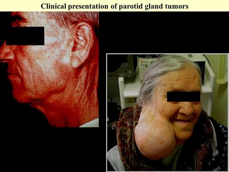 Clinical presentation of parotid gland tumors