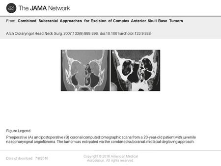 Date of download: 7/8/2016 Copyright © 2016 American Medical Association. All rights reserved. From: Combined Subcranial Approaches for Excision of Complex.