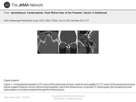 Date of download: 7/8/2016 Copyright © 2016 American Medical Association. All rights reserved. From: Spontaneous Cerebrospinal Fluid Rhinorrhea of the.