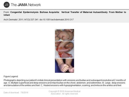 Date of download: 7/8/2016 Copyright © 2016 American Medical Association. All rights reserved. From: Congenital Epidermolysis Bullosa Acquisita: Vertical.