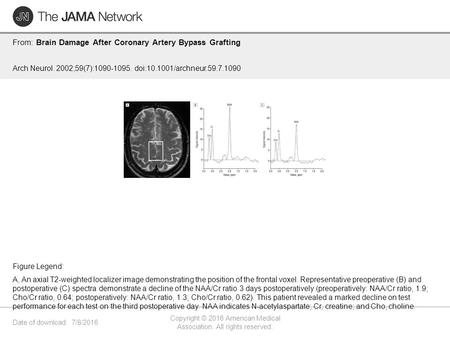 Date of download: 7/8/2016 Copyright © 2016 American Medical Association. All rights reserved. From: Brain Damage After Coronary Artery Bypass Grafting.