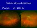 Posterior Vitreous Detachment 57 yo WM VA = 20/20 OU.