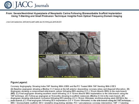 Date of download: 7/9/2016 Copyright © The American College of Cardiology. All rights reserved. From: Severe Neointimal Hyperplasia of Neoplastic Carina.