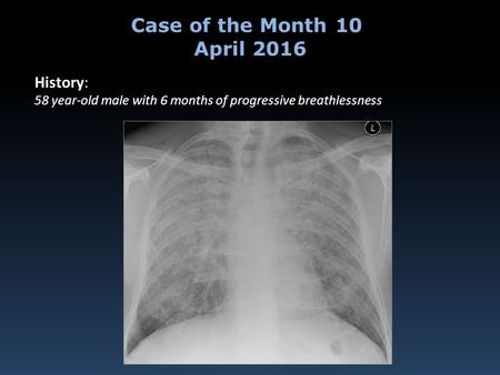 History: 58 year-old male with 6 months of progressive breathlessness Case of the Month 10 April 2016.