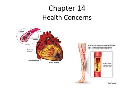 Chapter 14 Health Concerns. Cardiovascular Disease Atherosclerosis-narrowing of the coronary arteries. Dyslipidermia-abnormal blood proteins, LDL or HDL.