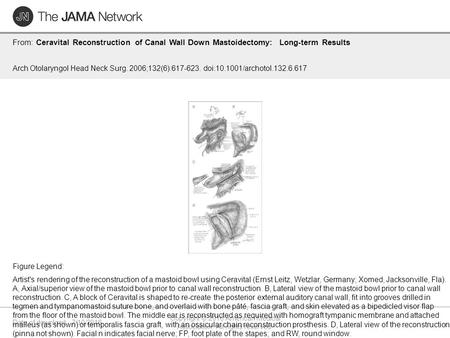 Date of download: 7/10/2016 Copyright © 2016 American Medical Association. All rights reserved. From: Ceravital Reconstruction of Canal Wall Down Mastoidectomy: