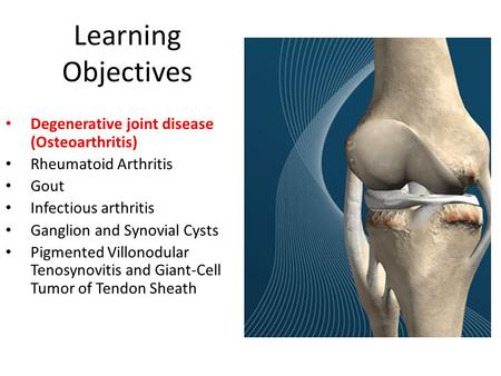 Learning Objectives Degenerative joint disease (Osteoarthritis)