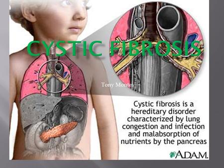 Tony Montes.  Cystic fibrosis is caused by a defective gene.