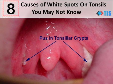 Causes of White Spots On Tonsils You May Not Know 8.