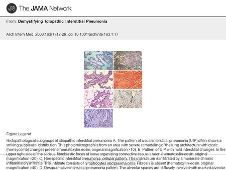 Date of download: 9/17/2016 Copyright © 2016 American Medical Association. All rights reserved. From: Demystifying Idiopathic Interstitial Pneumonia Arch.