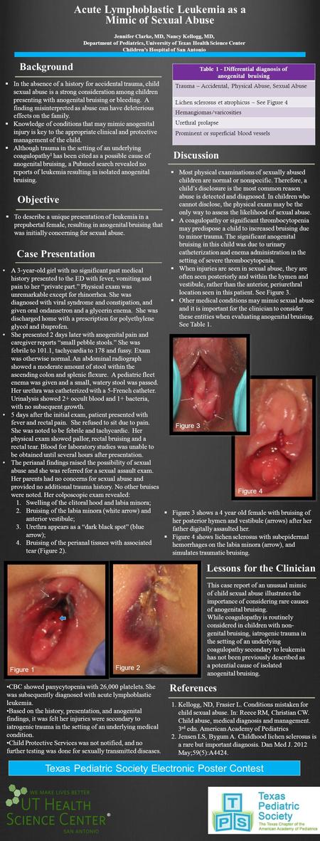 ® Acute Lymphoblastic Leukemia as a Mimic of Sexual Abuse Jennifer Clarke, MD, Nancy Kellogg, MD, Department of Pediatrics, University of Texas Health.