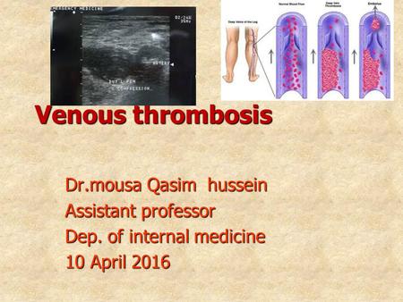 Venous thrombosis Dr.mousa Qasim hussein Assistant professor Dep. of internal medicine 10 April 2016.