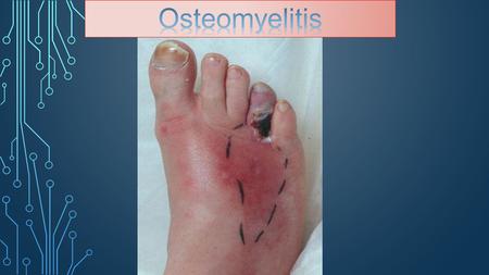 Osteomyelitis symptoms include: Fever, chills Irritability, lethargy in children Pain in the immediate area of the infection Swelling, warmth and.