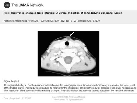 Date of download: 9/18/2016 Copyright © 2016 American Medical Association. All rights reserved. From: Recurrence of a Deep Neck Infection: A Clinical Indication.