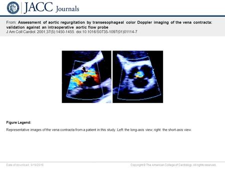 Date of download: 9/19/2016 Copyright © The American College of Cardiology. All rights reserved. From: Assessment of aortic regurgitation by transesophageal.