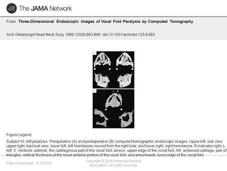 Date of download: 9/19/2016 Copyright © 2016 American Medical Association. All rights reserved. From: Three-Dimensional Endoscopic Images of Vocal Fold.