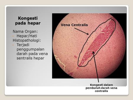 Kongesti pada hepar Nama Organ: Hepar/Hati Histopathologi: Terjadi penggumpalan darah pada vena sentralis hepar Kongesti dalam pembuluh darah vena centralis.