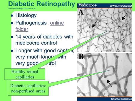 Diabetic Retinopathy Histology Pathogenesis online folderonline folder 14 years of diabetes with medicocre control Longer.