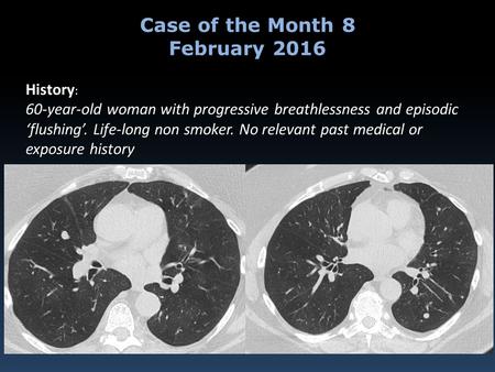 History : 60-year-old woman with progressive breathlessness and episodic ‘flushing’. Life-long non smoker. No relevant past medical or exposure history.