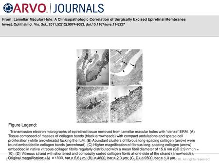 From: Lamellar Macular Hole: A Clinicopathologic Correlation of Surgically Excised Epiretinal Membranes Invest. Ophthalmol. Vis. Sci.. 2011;52(12):9074-9083.