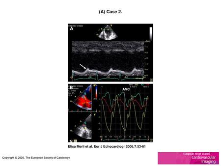 (A) Case 2. (A) Case 2. Anatomical M-mode of the apical septum on admission showing the absence of systolic thickening with marked post-systolic thickening.