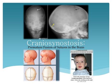 Premature Fusion of Sutures in the Brain