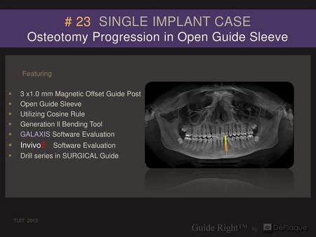 # 23 SINGLE IMPLANT CASE Osteotomy Progression in Open Guide Sleeve