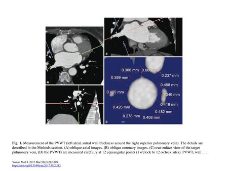 Fig. 1. Measurement of the PVWT (left atrial antral wall thickness around the right superior pulmonary vein). The details are described in the Methods.