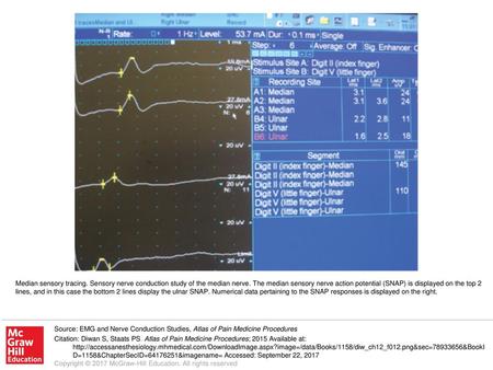 Median sensory tracing