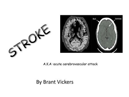 A.K.A :acute cerebrovascular attack