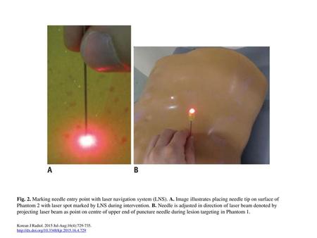 Fig. 2. Marking needle entry point with laser navigation system (LNS)