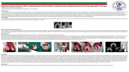 Application of platelet-rich fibrin (A-PRF) and injectable platelet-rich fibrin (i-PRF) in combination of bone substitute material for alveolar ridge augmentation.