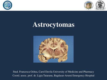 Astrocytomas Stud. Francesca Ochea, Carol Davila University of Medicine and Pharmacy Coord. assoc. prof. dr. Ligia Tataranu, Bagdasar-Arseni Emergency.