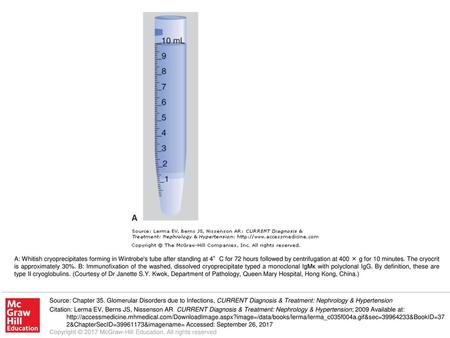 A: Whitish cryoprecipitates forming in Wintrobe's tube after standing at 4°C for 72 hours followed by centrifugation at 400 × g for 10 minutes. The cryocrit.