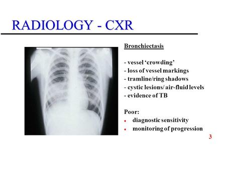 RADIOLOGY - CXR Bronchiectasis - vessel ‘crowding’