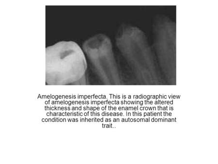 Amelogenesis imperfecta