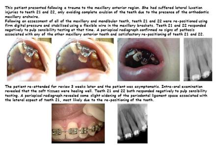 This patient presented following a trauma to the maxillary anterior region. She had suffered lateral luxation injuries to teeth 21 and 22, only avoiding.