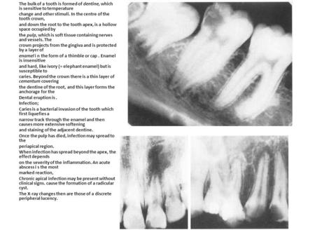 The bulk of a tooth is formed of dentine, which is sensitive to ternperature change and other stimuli. In the centre of the tooth crown, and down the root.