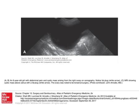 (A, B) An 8-year-old girl with abdominal pain and cystic mass arising from the right ovary on sonography. Notice fat plug (white arrow). (C) MRI showing.