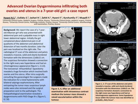 Advanced Ovarian Dysgerminoma infiltrating both ovaries and uterus in a 7-year-old girl: a case report Hyseni N.S.1, Llullaku S.2, Jashari H.1, Zahiti.