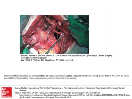 Dissection of the distal ureter. (A) Urinary bladder