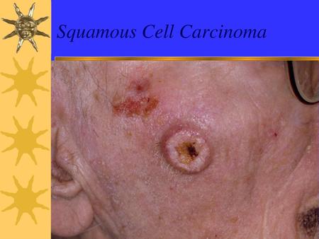 Squamous Cell Carcinoma