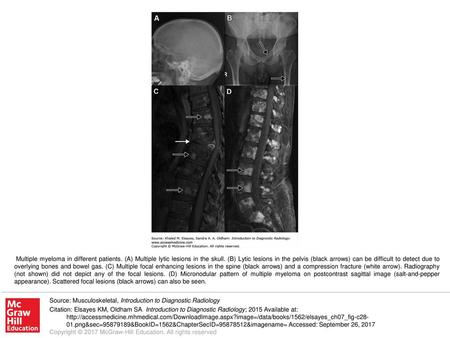 Multiple myeloma in different patients